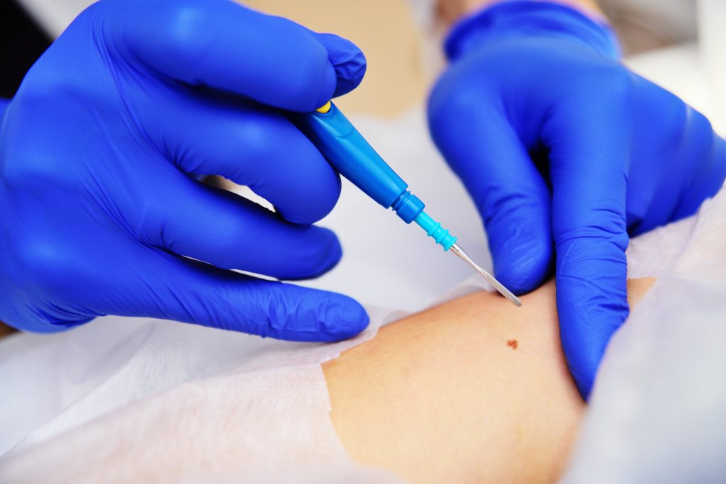 بیوپسی F/بیوپسی