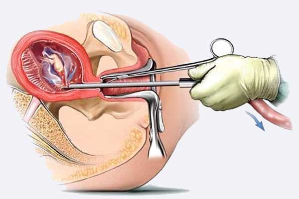 F/بیوپسی دهانه رحم