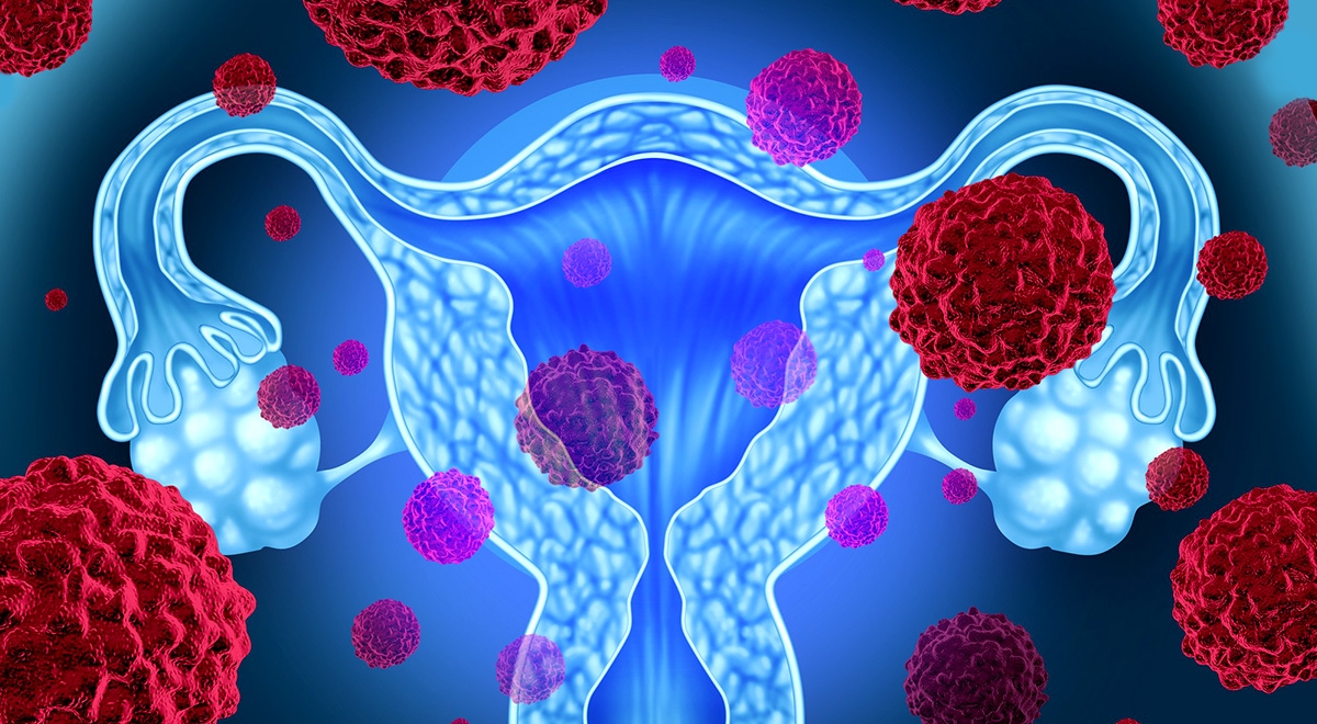 تصویر اندومتریوز َs/تصویر اندومتریوز