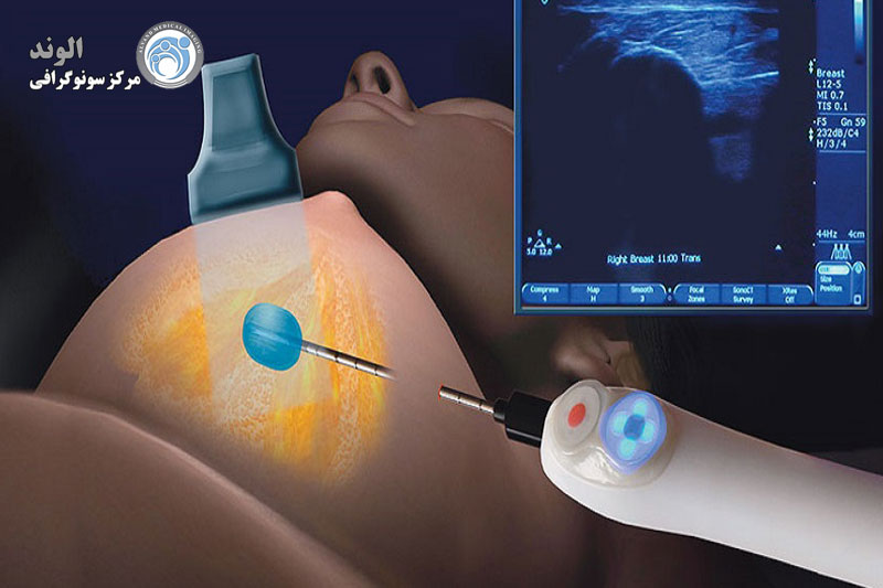 x/بیوپسی پستان