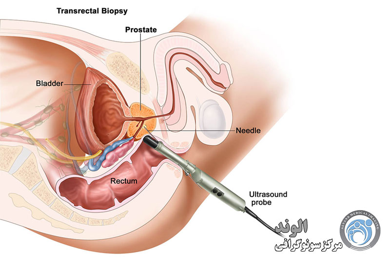 بیوپسی پروستات | مراقبت بعد نمونه برداری پروستات |نمونه برداری پروستات