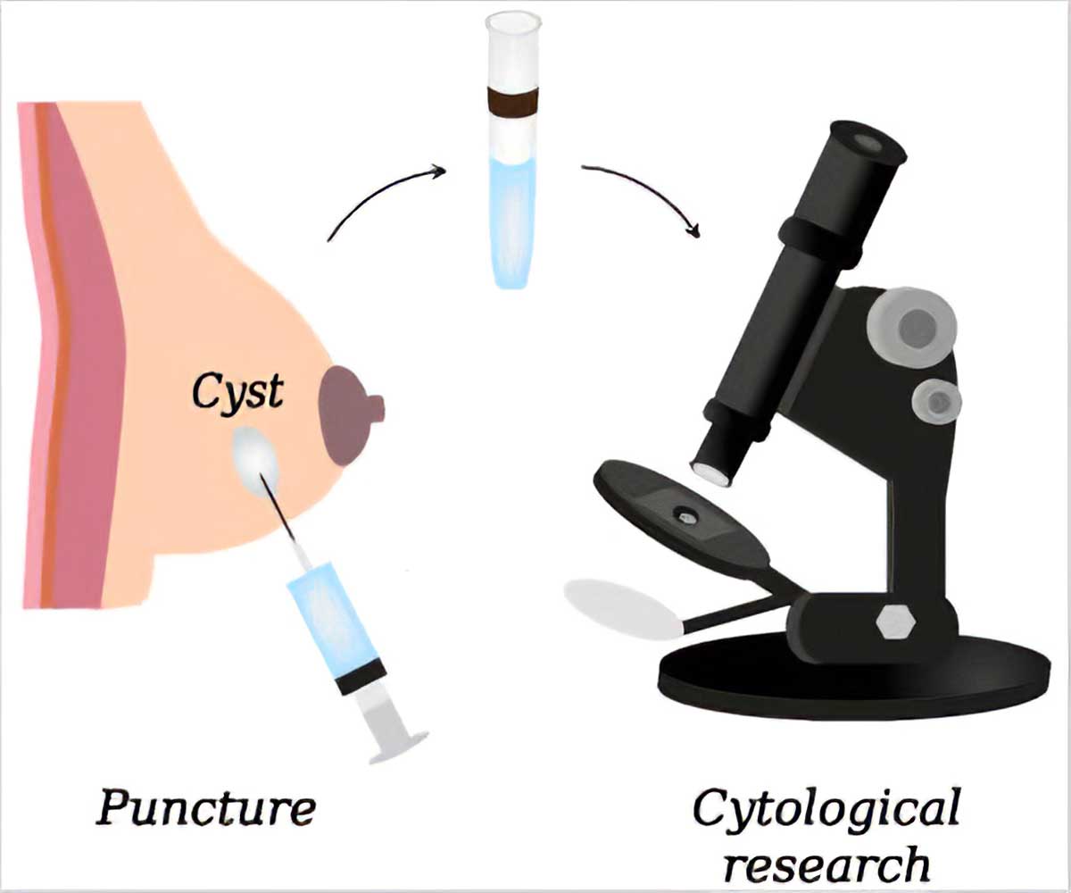 بیوپسی سینه b/ بیوپسی سینه
