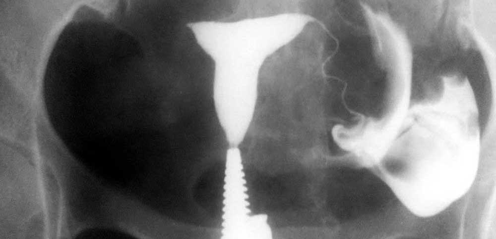 هیستروسالپنگوگرافی r/هیستروسالپنگوگرافی