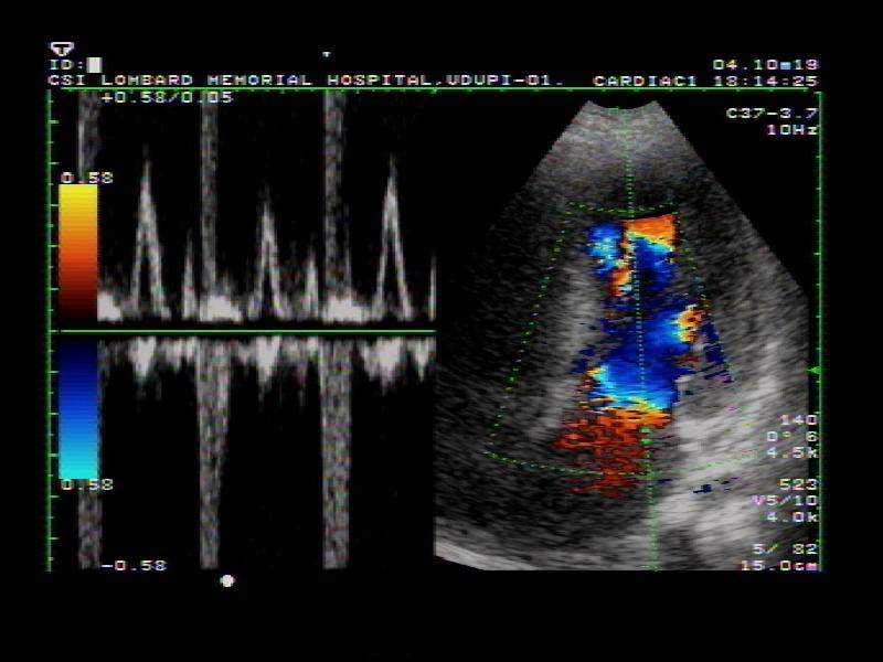 اکوکاردیوگرافی جنین f/اکوکاردیوگرافی جنین