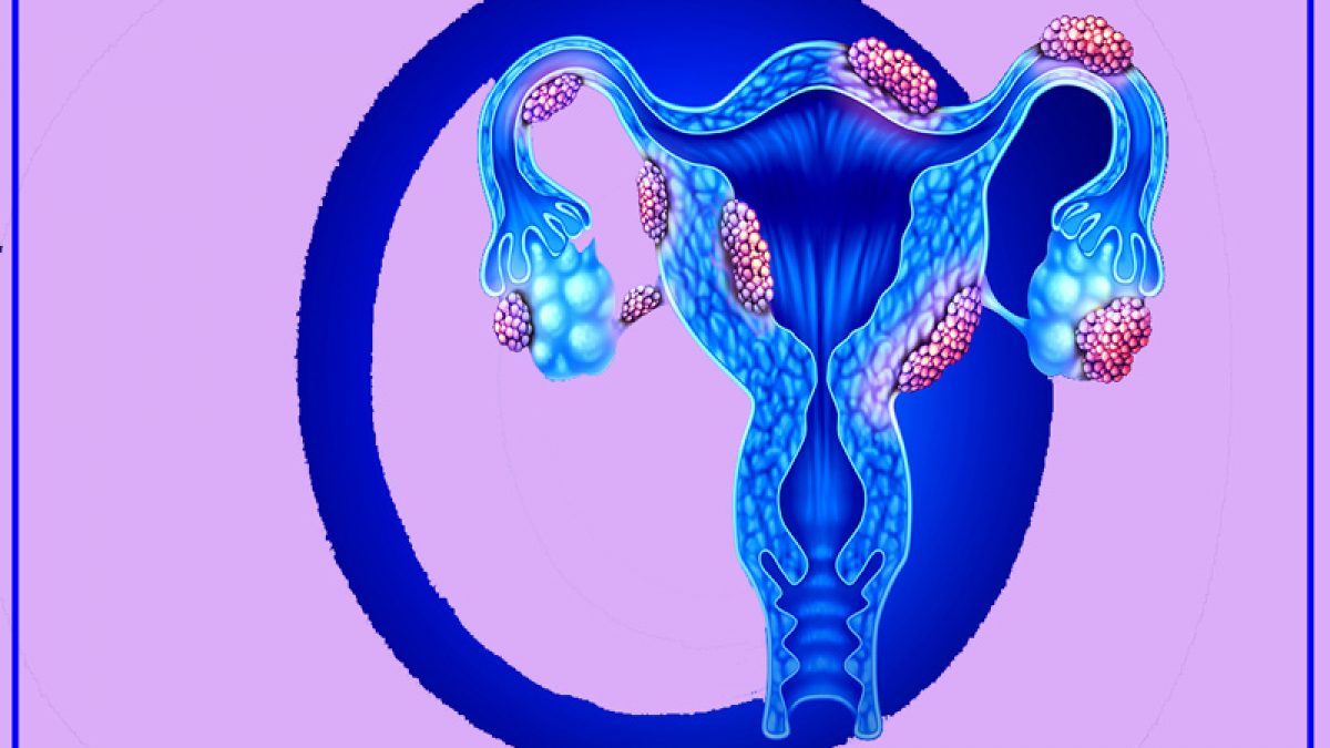 تشخیص اندومتریوز باآزمایش خون s/تشخیص اندومتریوز باآزمایش خون