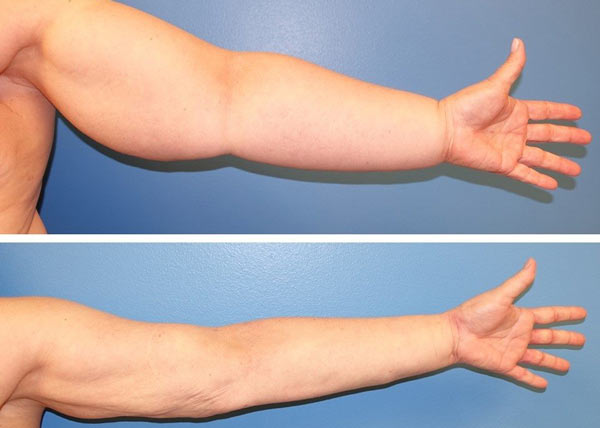 درمان لنف ادم چیست؟ j/درمان لنف ادم چیست؟