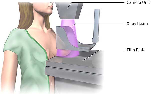 ماموگرافی چیست و چطور انجام می شود؟ mammogram/ماموگرافی چیست و چطور انجام می شود؟