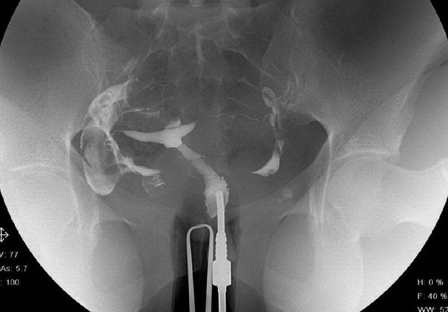 هیستروسالپنگوگرافی y/هیستروسالپنگوگرافی