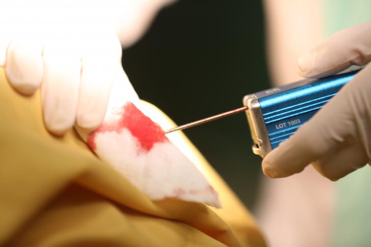 بیوپسی سینه l/بیوپسی سینه