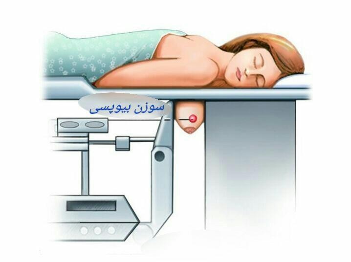 بیوپسی سینه e/بیوپسی سینه