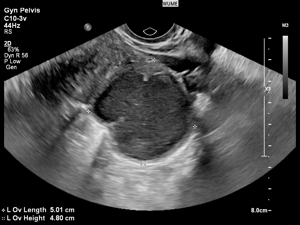 بهترین زمان برای سونوگرافی واژینال The best time for a vaginal ultrasound/بهترین زمان برای سونوگرافی واژینال