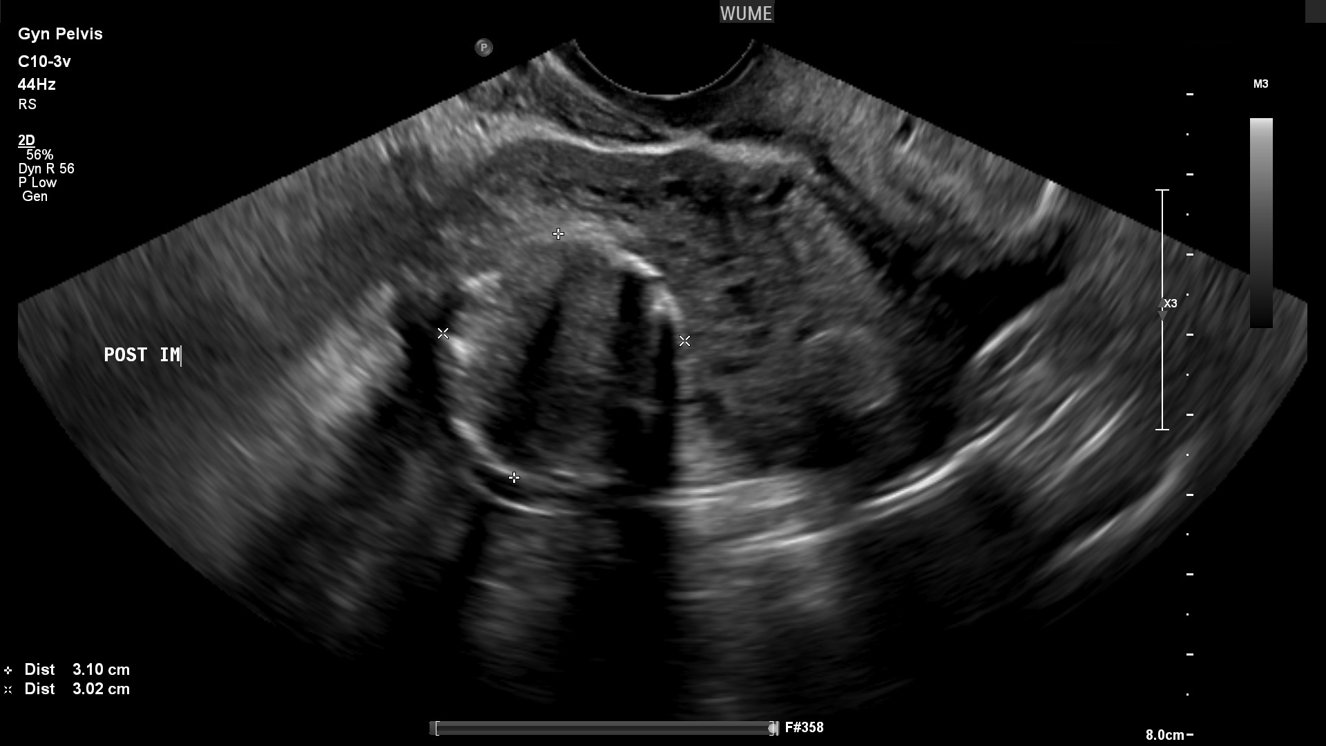 بهترین زمان برای سونوگرافی واژینال The best time for a vaginal ultrasound/بهترین زمان برای سونوگرافی واژینال