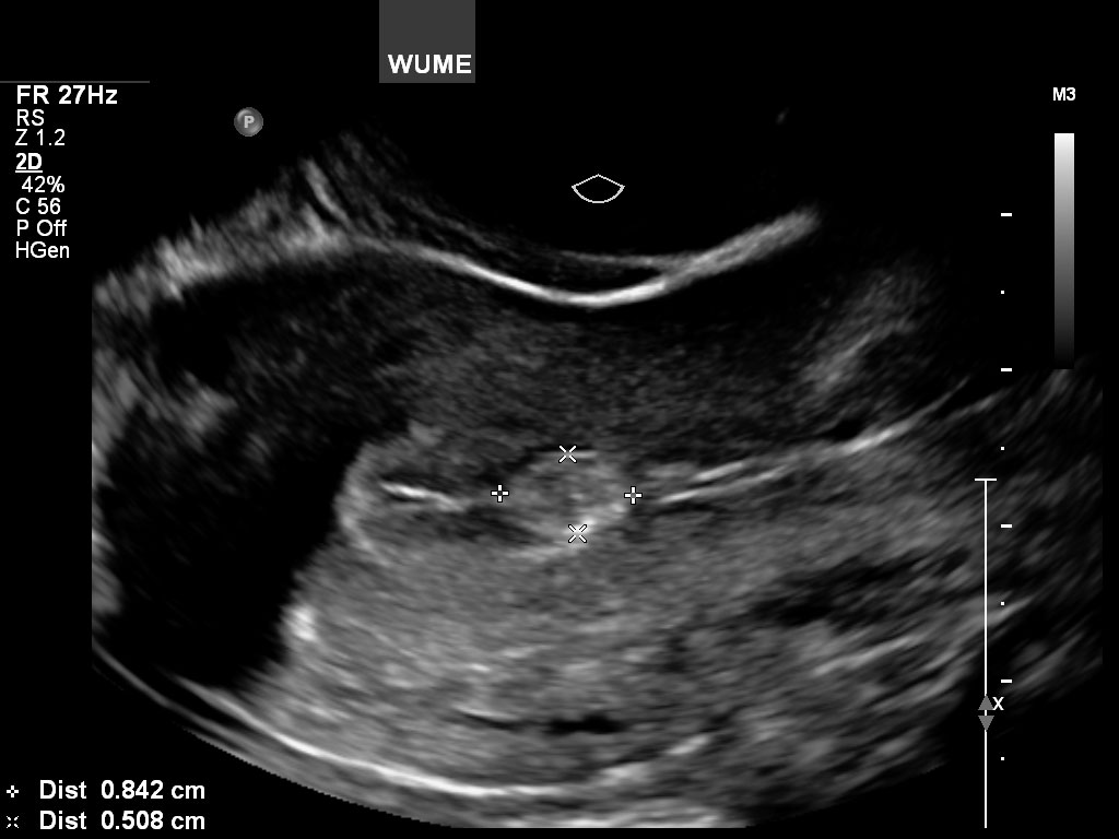 بهترین زمان برای سونوگرافی واژینال The best time for a vaginal ultrasound/بهترین زمان برای سونوگرافی واژینال