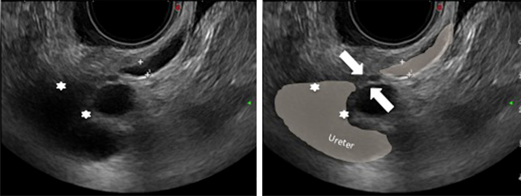 سونوگرافی سونو هیستروگرافی z/سونوگرافی سونو هیستروگرافی