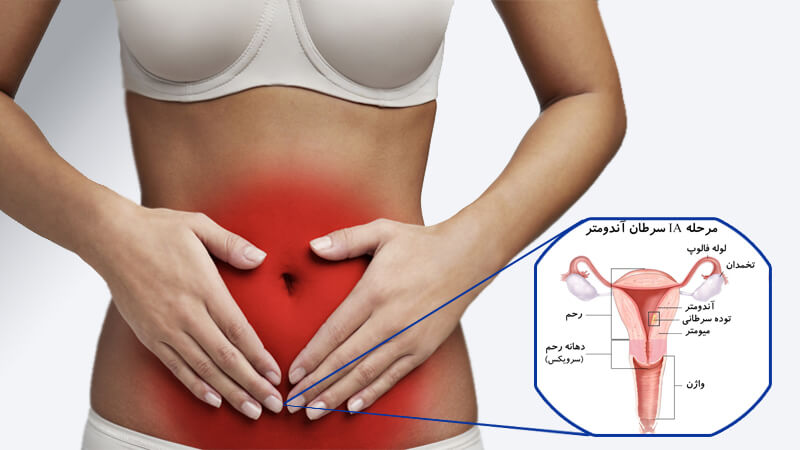 تصویر اندومتریوز d/تصویر اندومتریوز