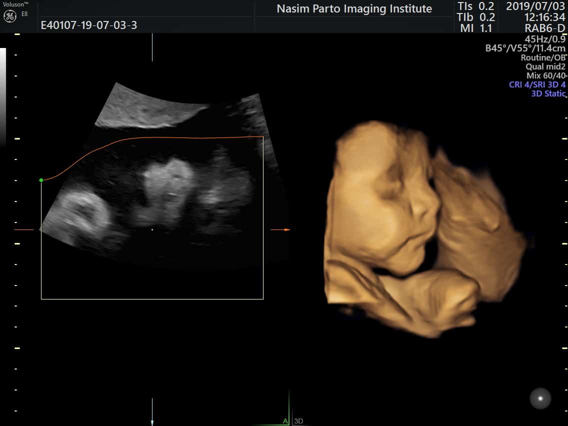 سونوگرافی آنومالی در تهران y/سونوگرافی آنومالی در تهران