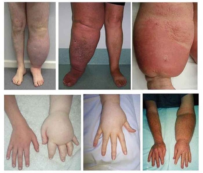 درمان لنف ادم چیست؟ h/درمان لنف ادم چیست؟