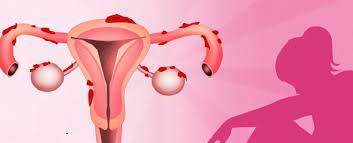 تشخیص اندومتریوز با آزمایش خون s|تشخیص اندومتریوز با آزمایش خون