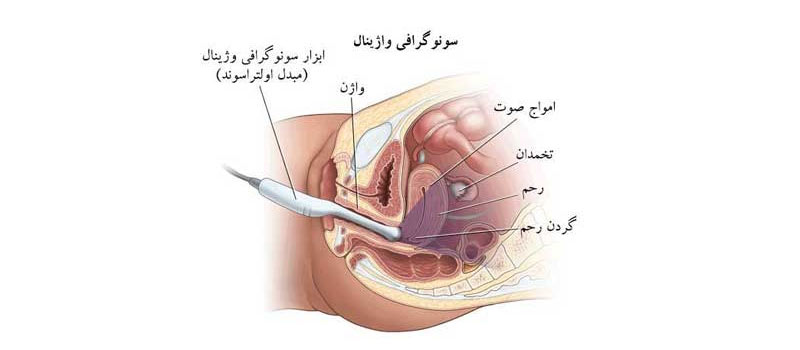 سونوگرافی واژینال در تهران Vaginal ultrasound in Tehran سونوگرافی واژینال در تهران Vaginal ultrasound in Tehran